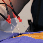Radiofrequency Ablation - Types, Procedure, Treatment and Recovery