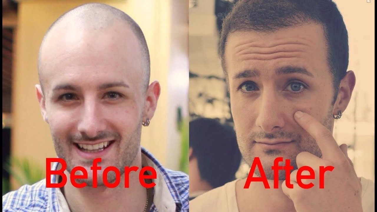 FUT and FUE Learn about the new hair restoration procedures
