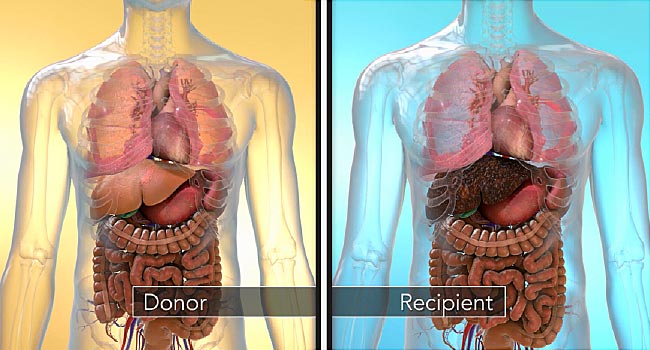 Facts about Liver Transplant Surgery