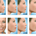 What to Expect From Corrective Jaw Surgery