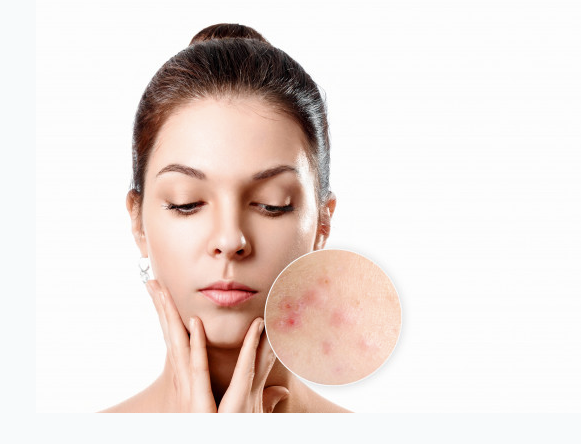 Acne- The Reasons and Remedies of it