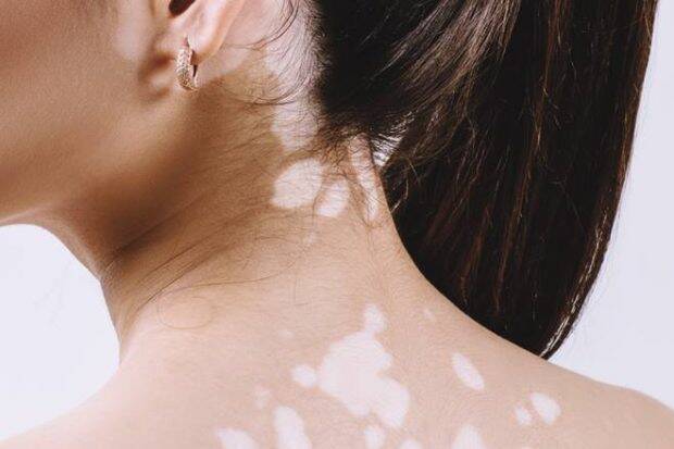 Is vitiligo contagious