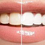 Teeth whitening in Noida