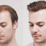 Best Hair loss solutions