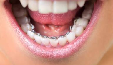 Are Invisalign better than braces?