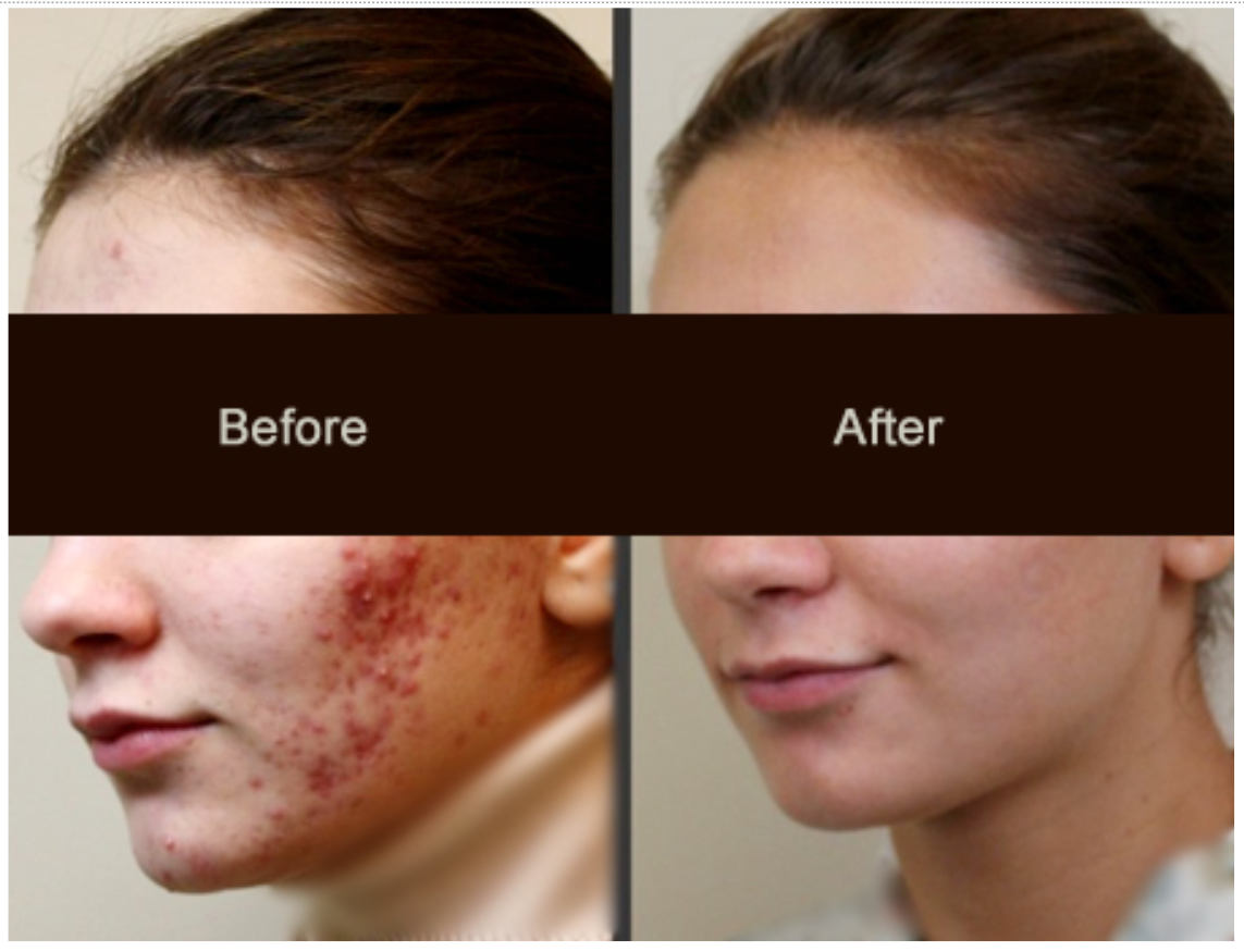Laser Treatment in Jaipur: Best Skin doctor for Acne
