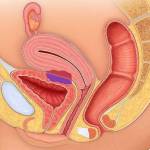 A Brief Guide To Treating Endometriosis 