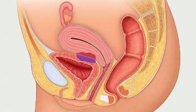 A Brief Guide To Treating Endometriosis 