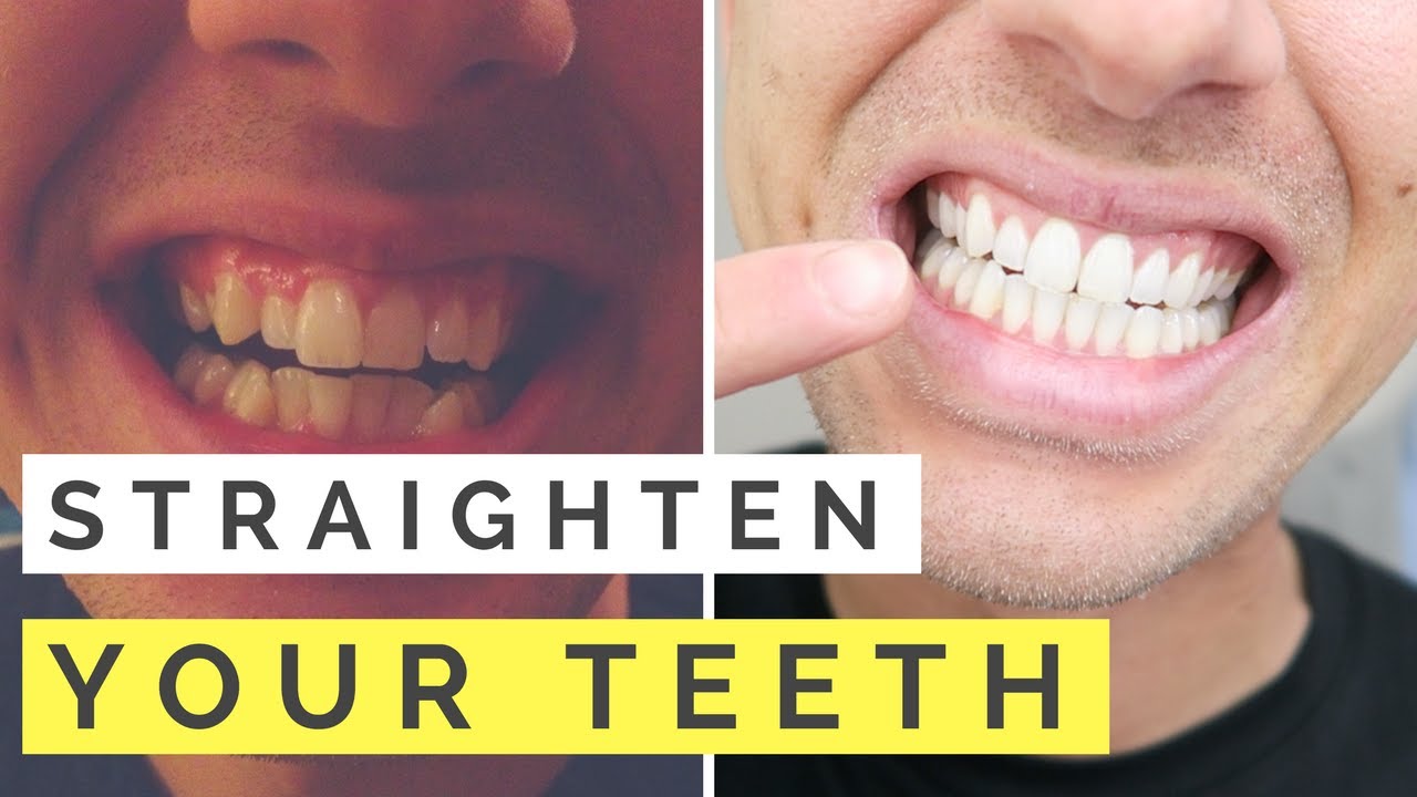 Straighten Your Teeth