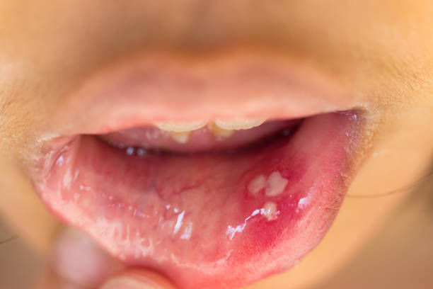mouth ulcers