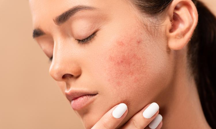 How Do I Get My Acne Under Control