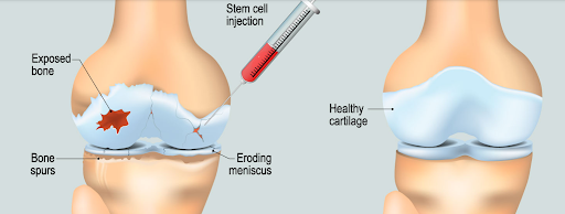 Stem Cell Injection Cost: How Much Is It