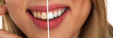 How You Can Get Your Teeth Whitened At Home
