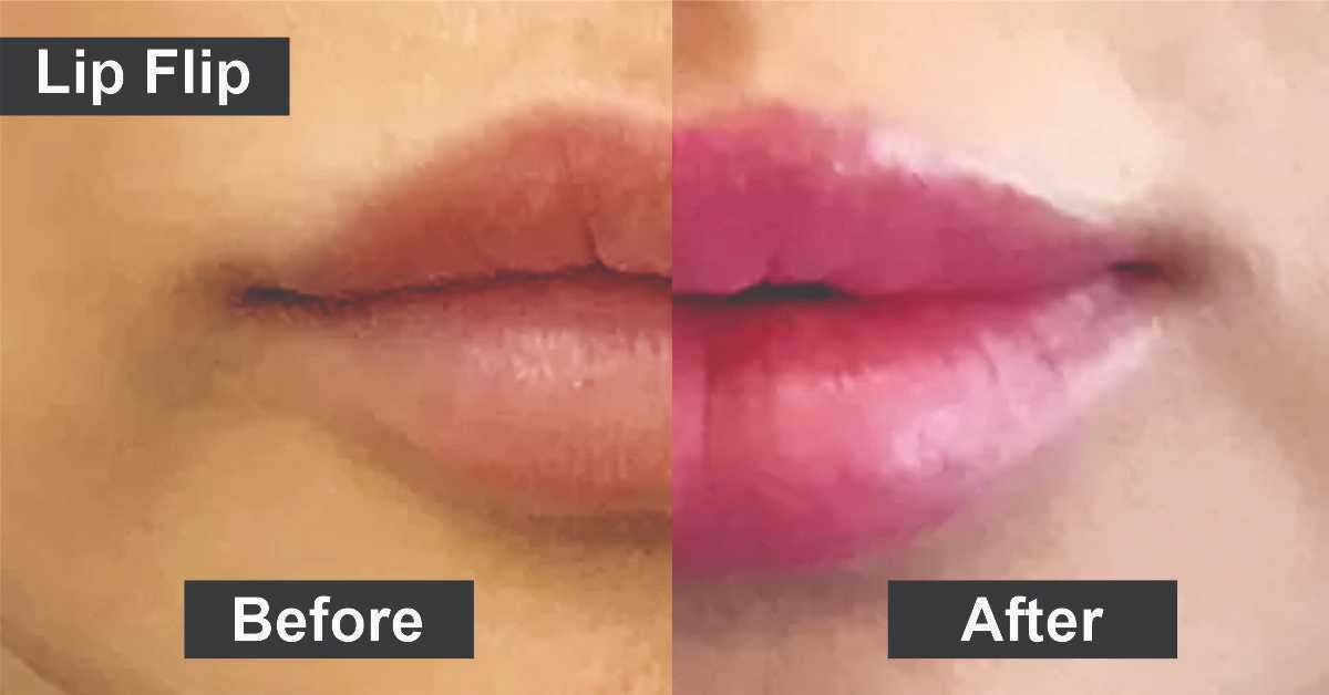 Lip Flip Before And After- Know Better About This Sensation
