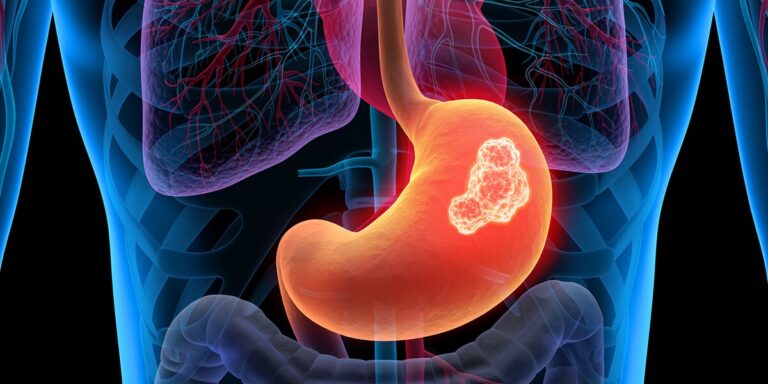 Löwenmähnenextrakt schützt vor der Entstehung von Magengeschwüren